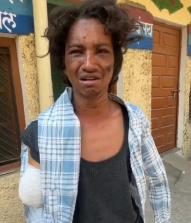 टिहरी: पारिवारिक विवाद में बड़े भाई ने मां और पत्नी संग मिलकर छोटे भाई पर किया जानलेवा हमला, दोनों हाथ काटने पड़े